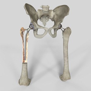 replacement hip 3D