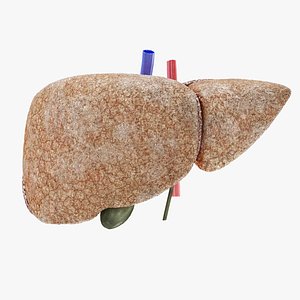 Fibrosis Liver