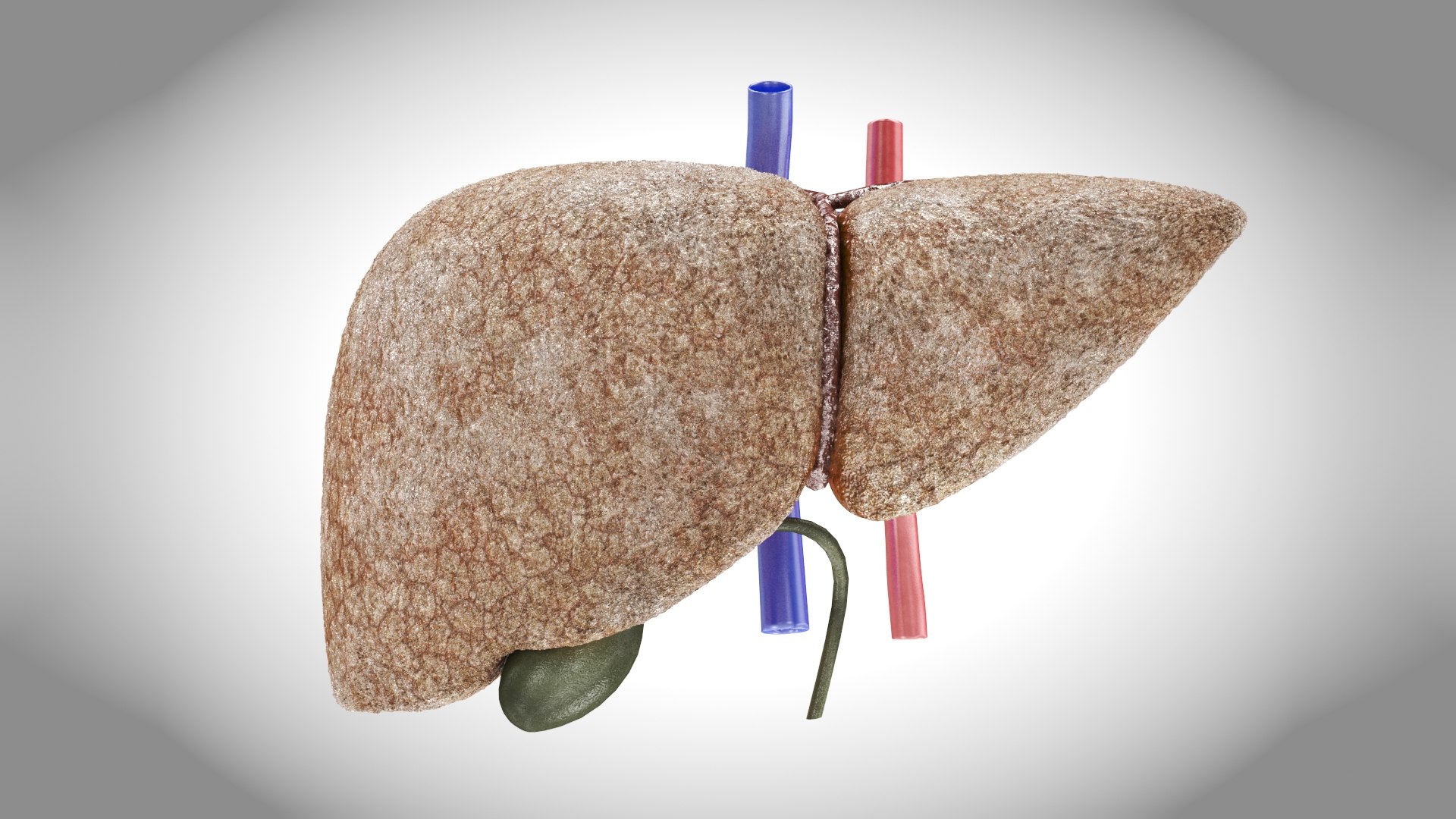 Fibrosis Liver 3D Model - TurboSquid 2132831