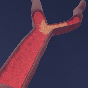 atherosclerosis 3D model