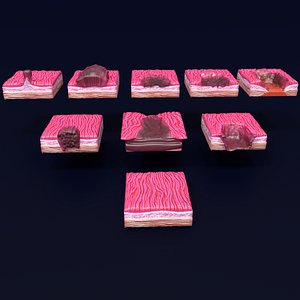 3D model stages gastric cancer