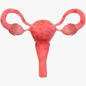 3D Uterine lesions uterine fibroids gynecological diseases model