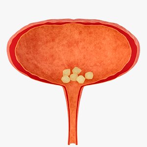 3D model Bladder stones cystitis  urinary system diseases