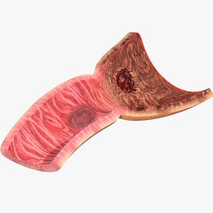 Peptic Ulcer Stomach duodenum