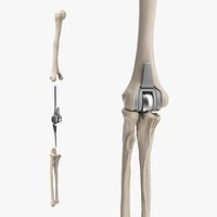 Elbow Joint Implant with Humerus and Ulna
