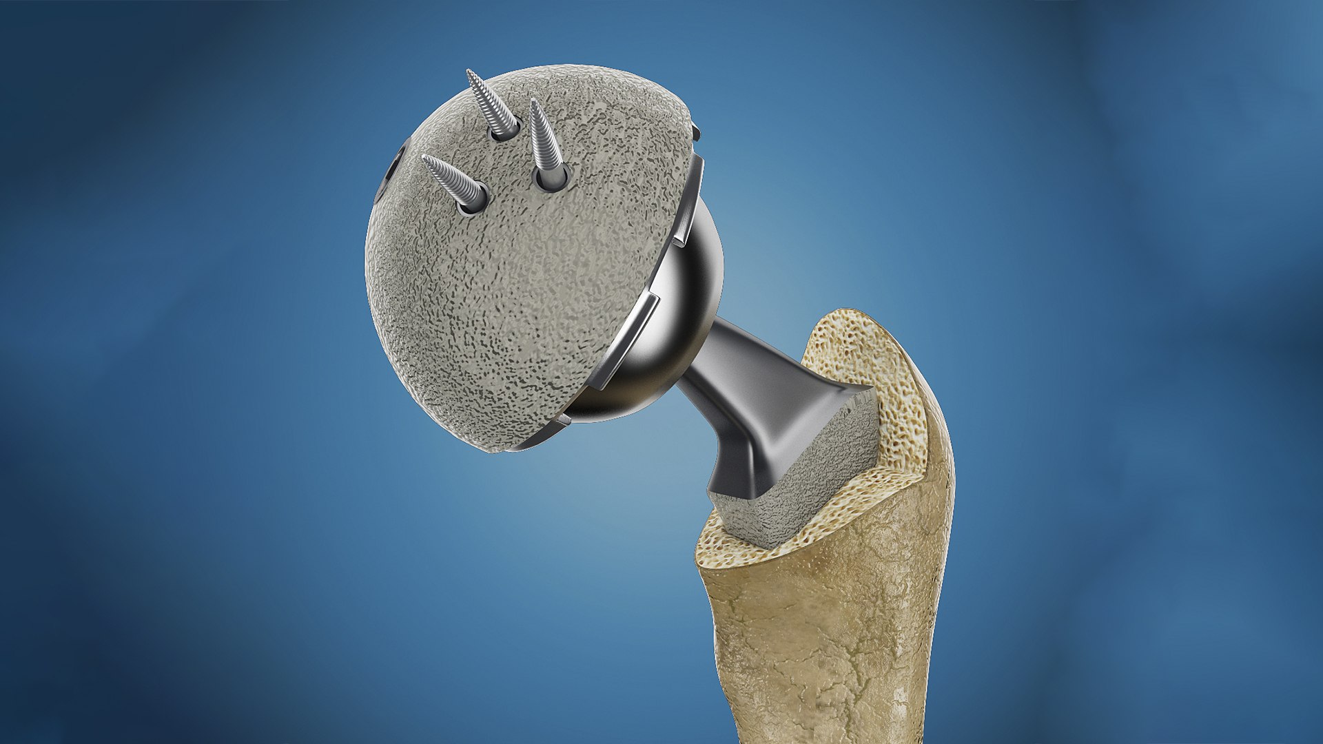 3ds femoral prosthesis tibia pelvis https://p.turbosquid.com/ts-thumb/G1/fKTkdO/Th/4ps2/jpg/1662651183/1920x1080/fit_q87/5065c34884a647dc9f6db2c609ca1ed1178c1f69/4ps2.jpg