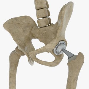 Femoral Prosthesis With Tibia And Pelvis