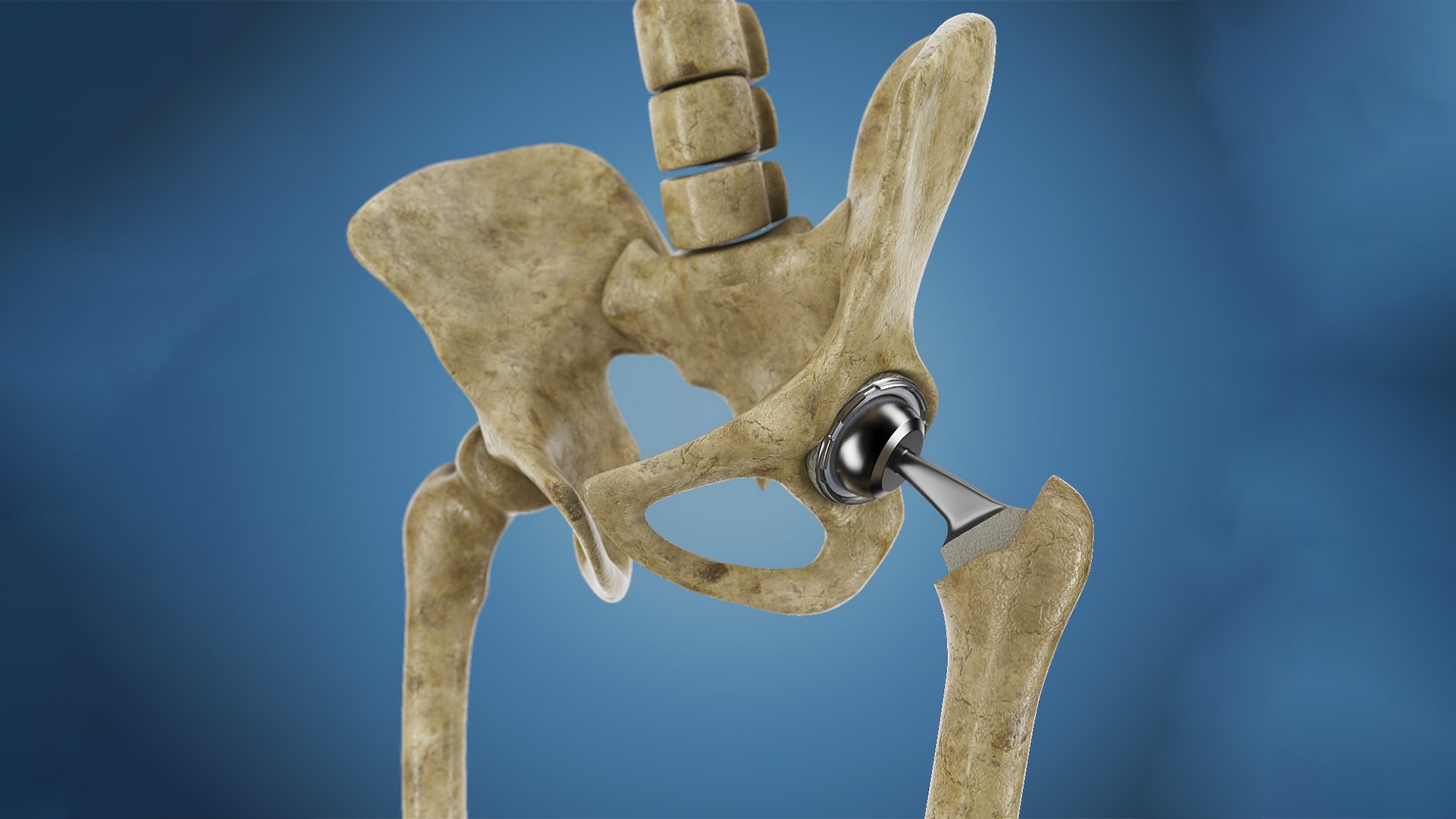 3ds femoral prosthesis tibia pelvis