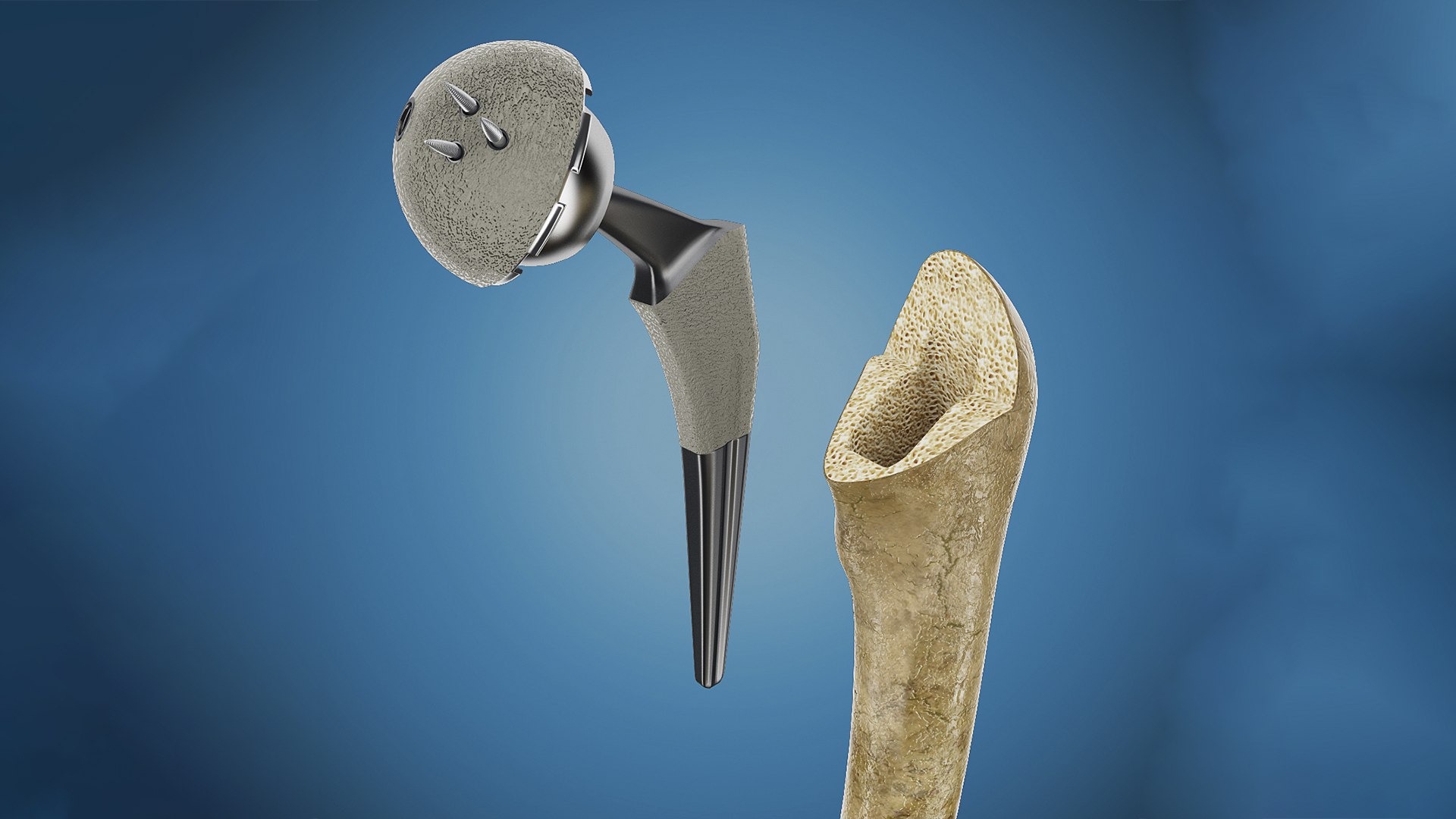 3ds femoral prosthesis tibia pelvis https://p.turbosquid.com/ts-thumb/G1/fKTkdO/pL/7ps2/jpg/1662651183/1920x1080/fit_q87/ebb466e10f09482650cc0e5ad0c4e1f8a8584afd/7ps2.jpg