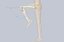 Knee Tumor Prosthesis