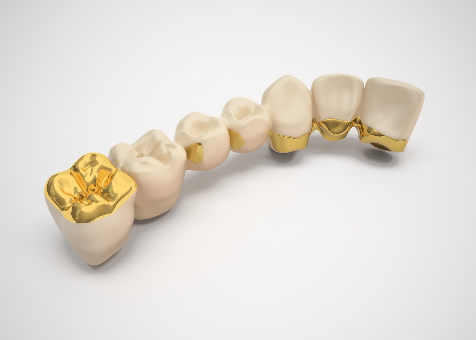 gold tooth bridge
