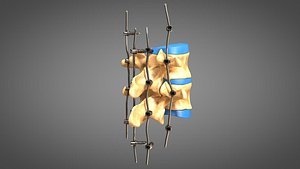 3D human spine fixators model