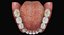 Mixed Dentition