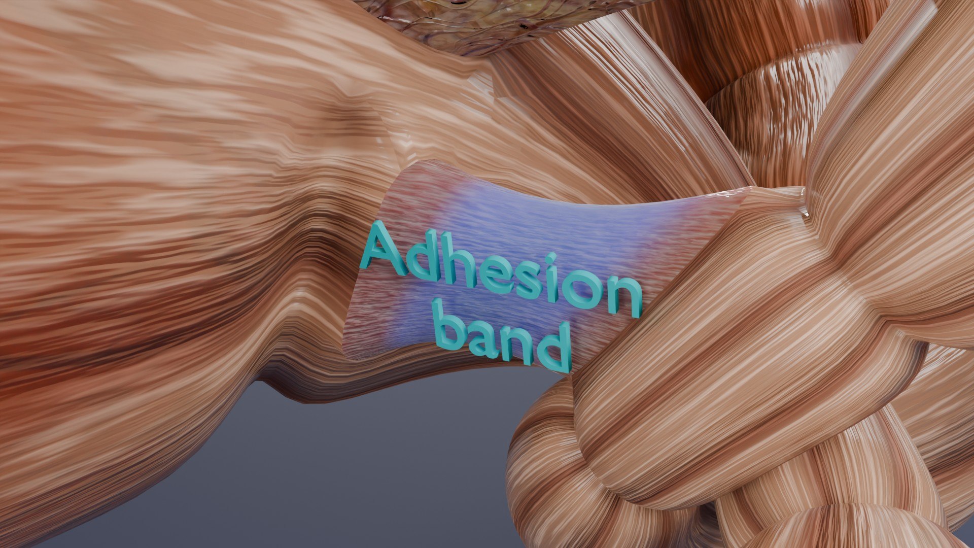 Volvulus Intestine Obstruction 3D - TurboSquid 2411401
