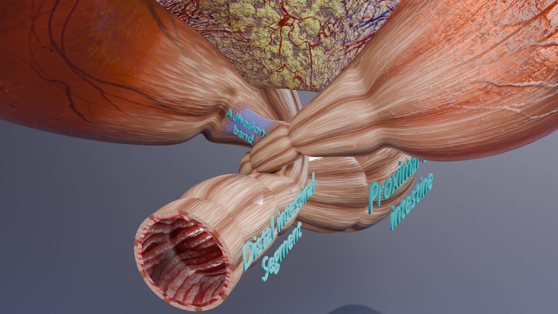 Volvulus Intestine Obstruction 3D - TurboSquid 2411401