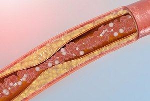 Blocked blood vessel animation