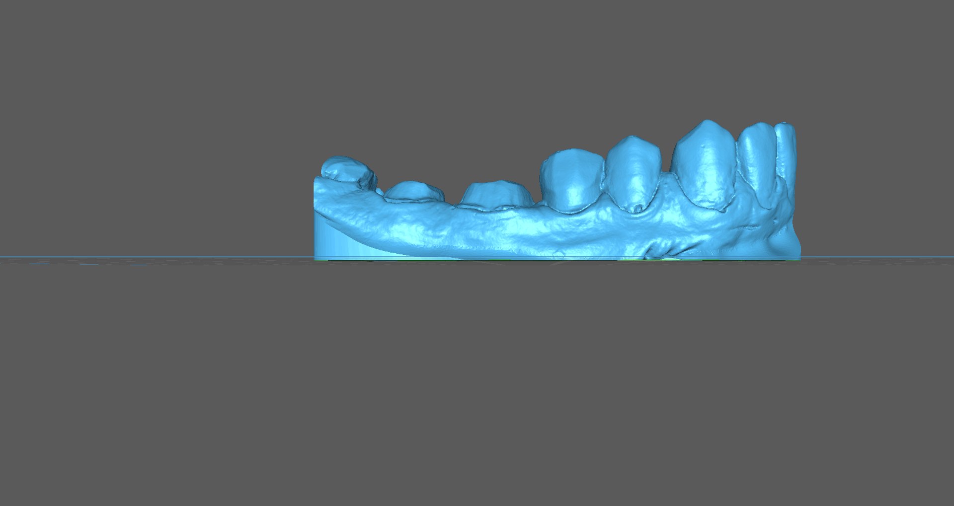 3D 2-Unit Dental Bridge Design Model - TurboSquid 2337409