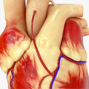 Coronary artery bypass grafting