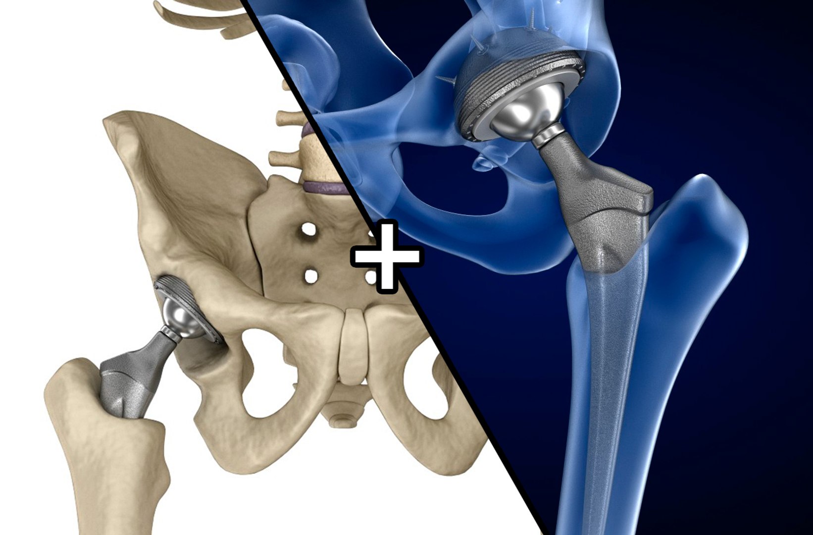 Normal Hip Joint Anatomy & Total Hip Replacement 3D Videos, Houston Texas