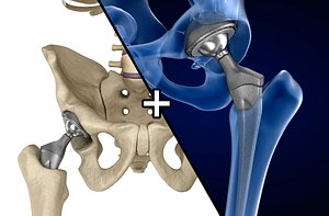 3D hip replacement implant installed model