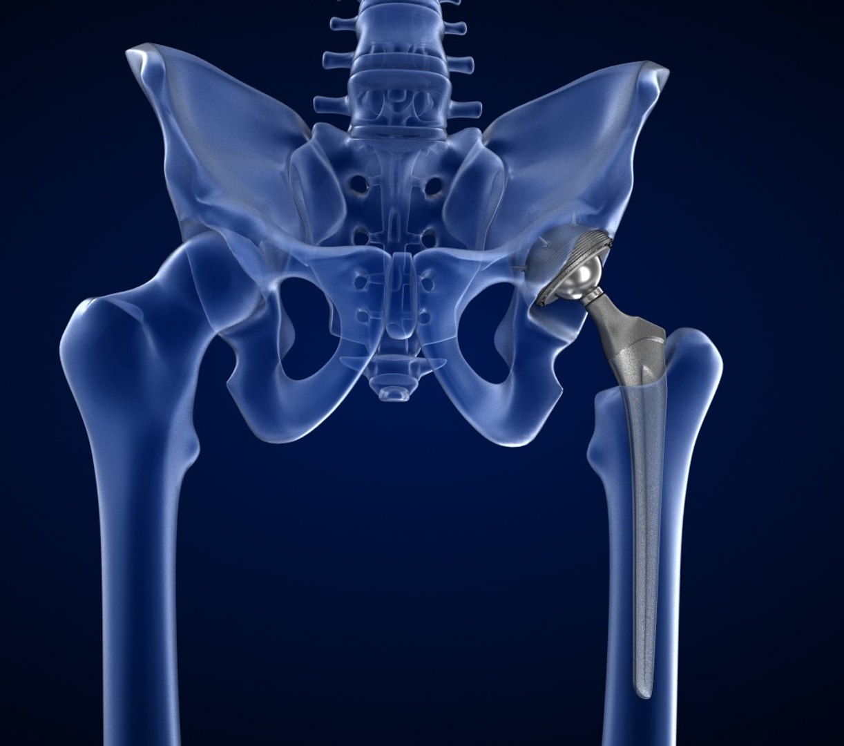 3D Hip Replacement Implant Installed Model - TurboSquid 1220758