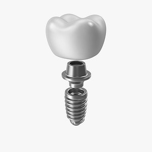 Tooth Implant Stylized 3D