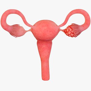 Ovarian cancer cysts uterine lesions gynecological diseases