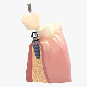 Dental Implant