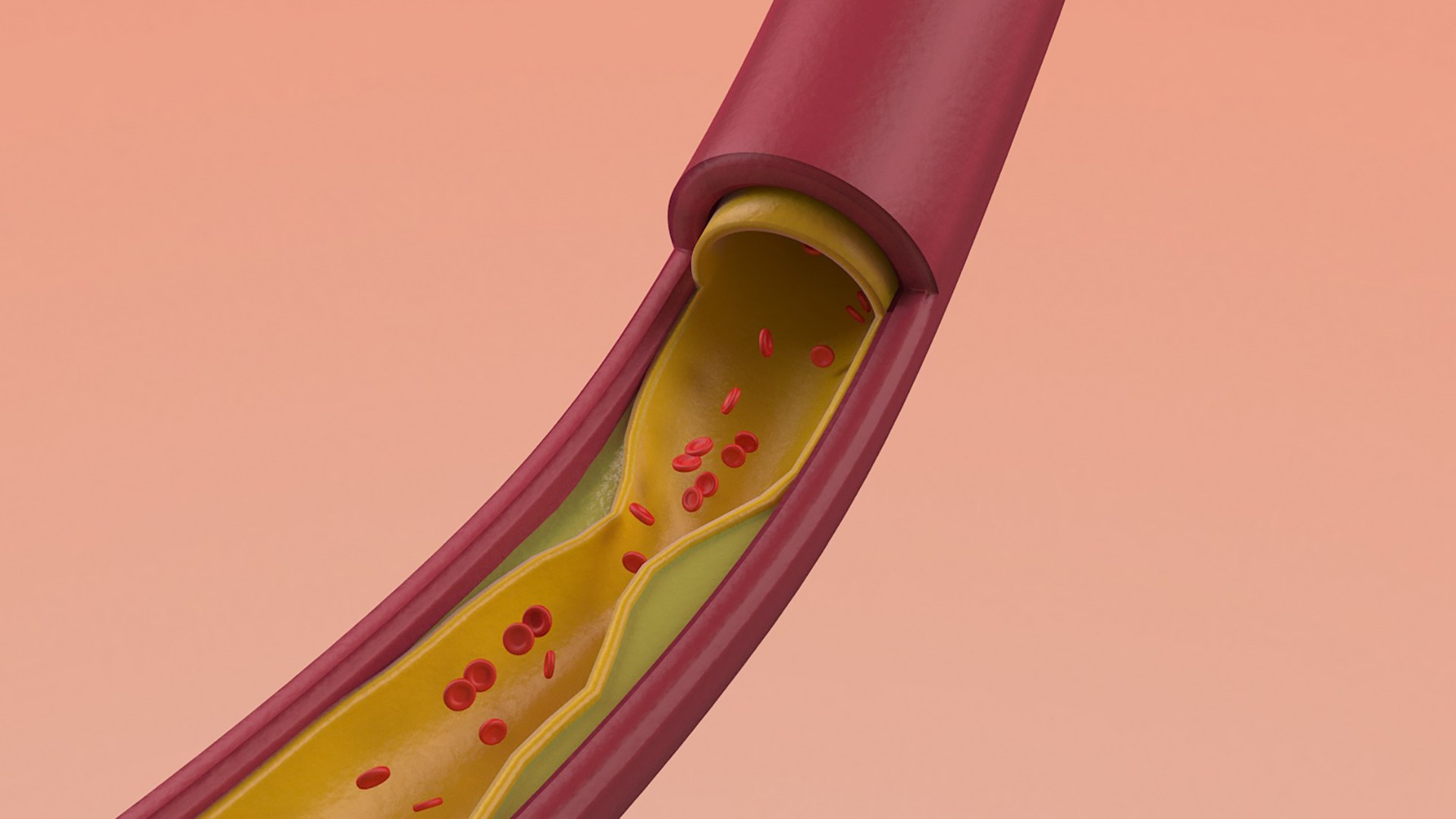 3D Artery Vein Clog https://p.turbosquid.com/ts-thumb/Jo/DmtAqr/VO/003/jpg/1655722584/1920x1080/fit_q87/f06a96671ff39ec714f6914fa08ab5eec5feaaa8/003.jpg