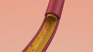 3D Artery Vein Clog