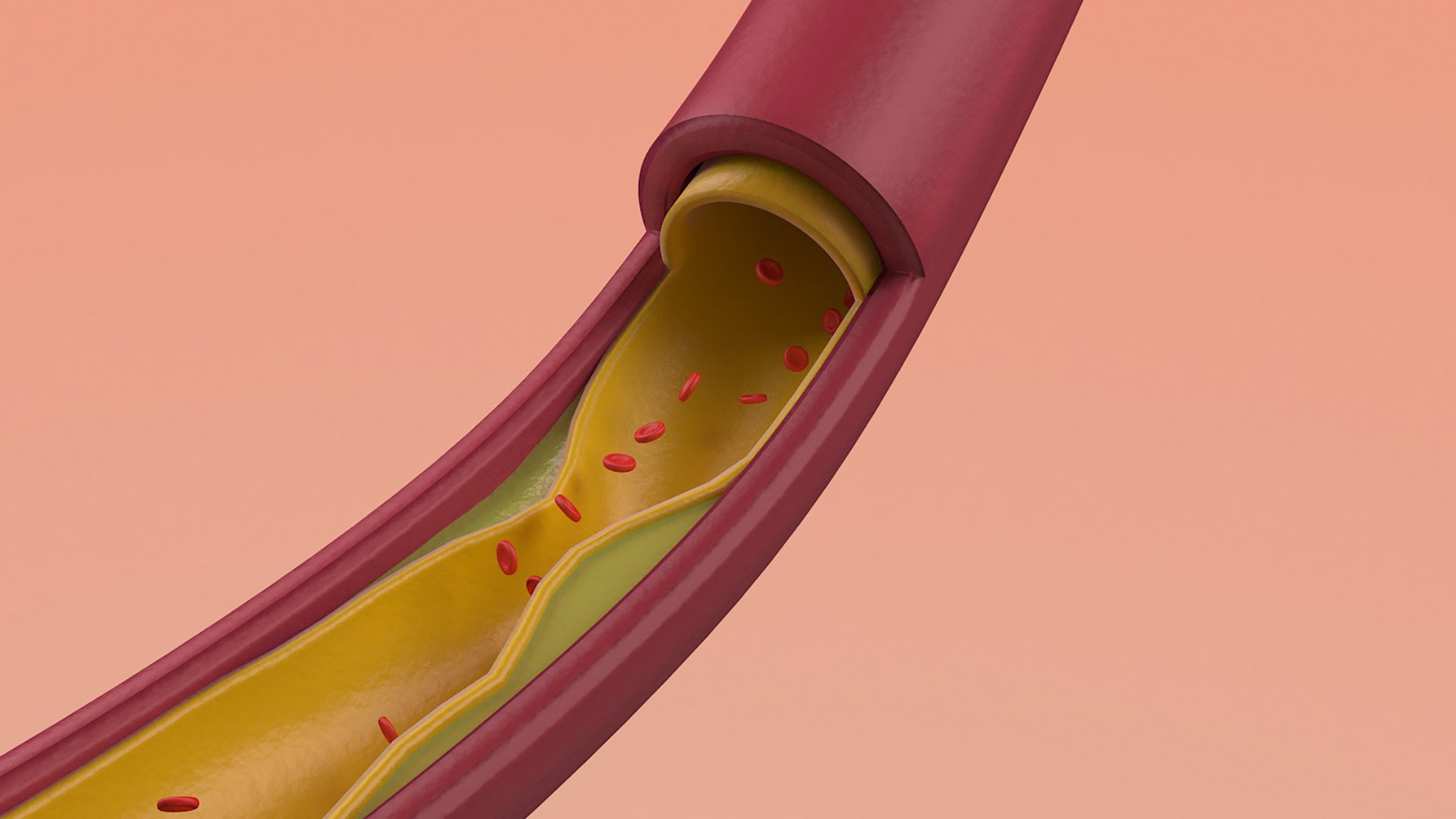 3D Artery Vein Clog https://p.turbosquid.com/ts-thumb/Jo/DmtAqr/ex/004/jpg/1655722709/1920x1080/fit_q87/cb2688c6a184db629913ba18f34dc08a43001d76/004.jpg