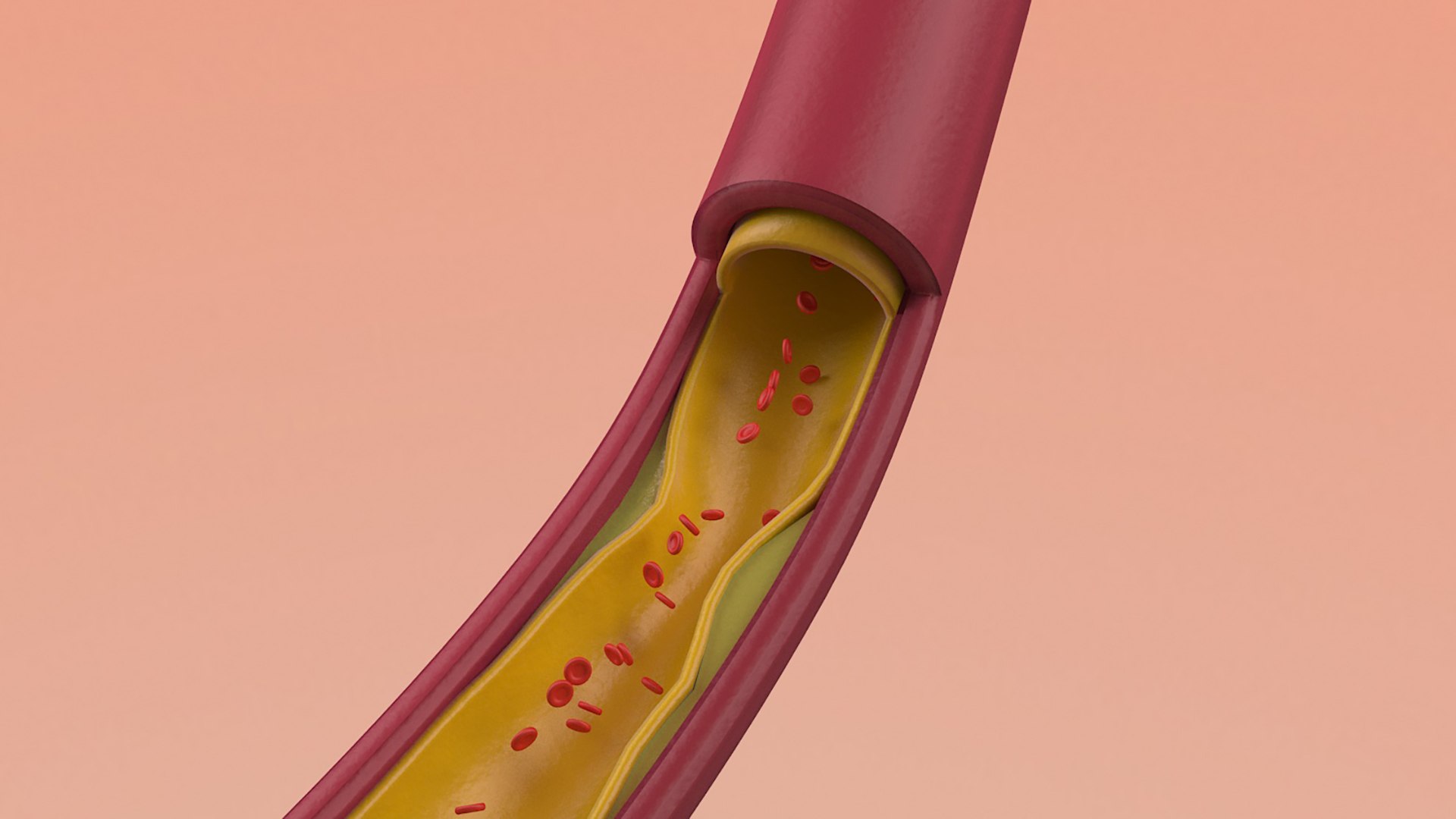 3D Artery Vein Clog https://p.turbosquid.com/ts-thumb/Jo/DmtAqr/mT/002/jpg/1655722583/1920x1080/fit_q87/4d1d82950accd18ae32c6bb100a42f6ec891e8b7/002.jpg