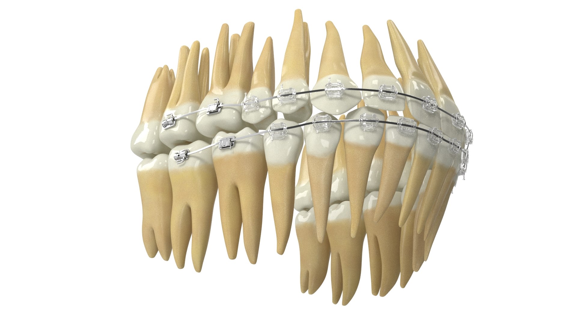 3D Human Teeth With Transparent Dental Braces V04 Model - TurboSquid ...