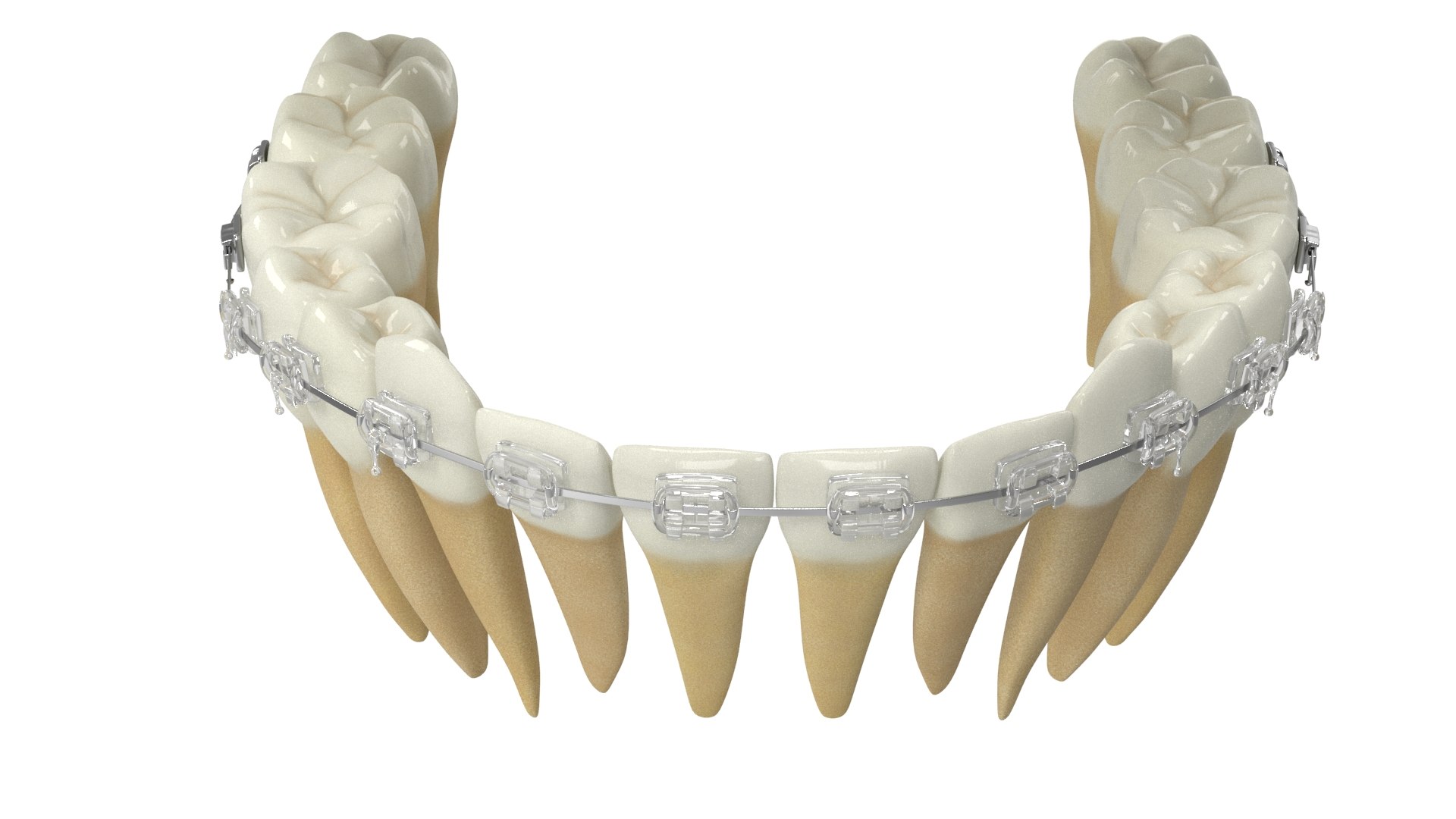 3D Human Teeth With Transparent Dental Braces V04 Model - TurboSquid ...