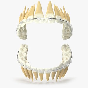 3D Human Teeth With Transparent Dental Braces V04 model