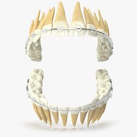 Human Teeth With Transparent Dental Braces V04