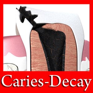 Teeth - Decay