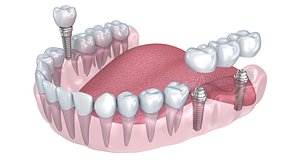 Lower teeth crown and dental implant
