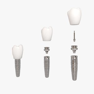 3D  Dental Implant
