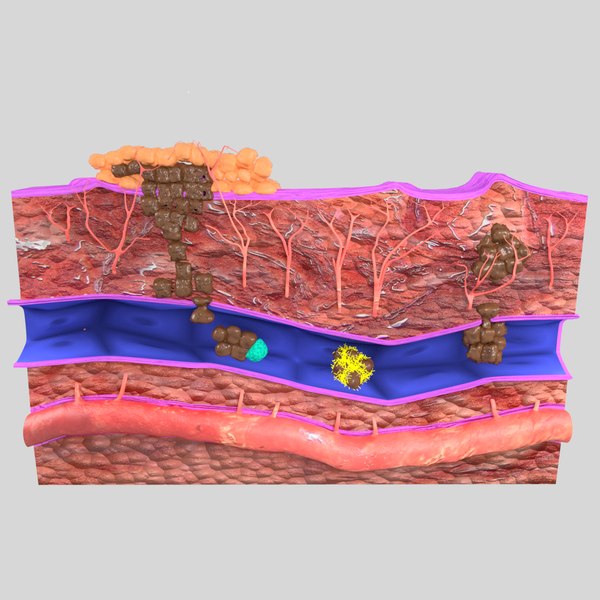 3D cancer spread model