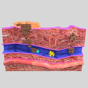 cancer metastasis spread