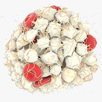Arterial Thrombus