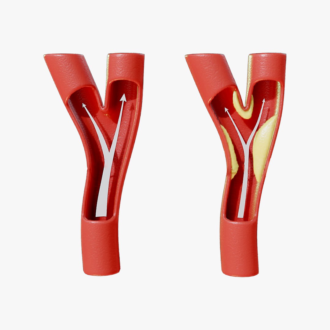 3D Peripheral Artery Disease TurboSquid 2157772