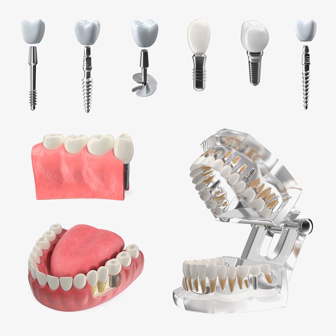 Tooth Implants Collection 3 3D model preview