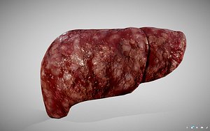 3D hepatocellular carcinoma hcc liver model