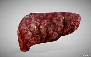 Hepatocellular Carcinoma (HCC) - Liver Cancer
