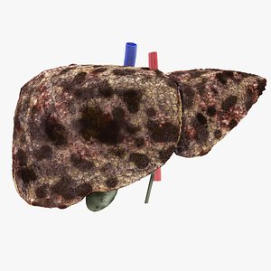 Hepatocellular Carcinoma Liver