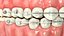 Bocca umana con apparecchi dentali trasparenti V04
