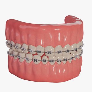 3D model Braces with elastic rubber bands