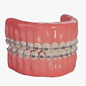 Braces with elastic rubber bands